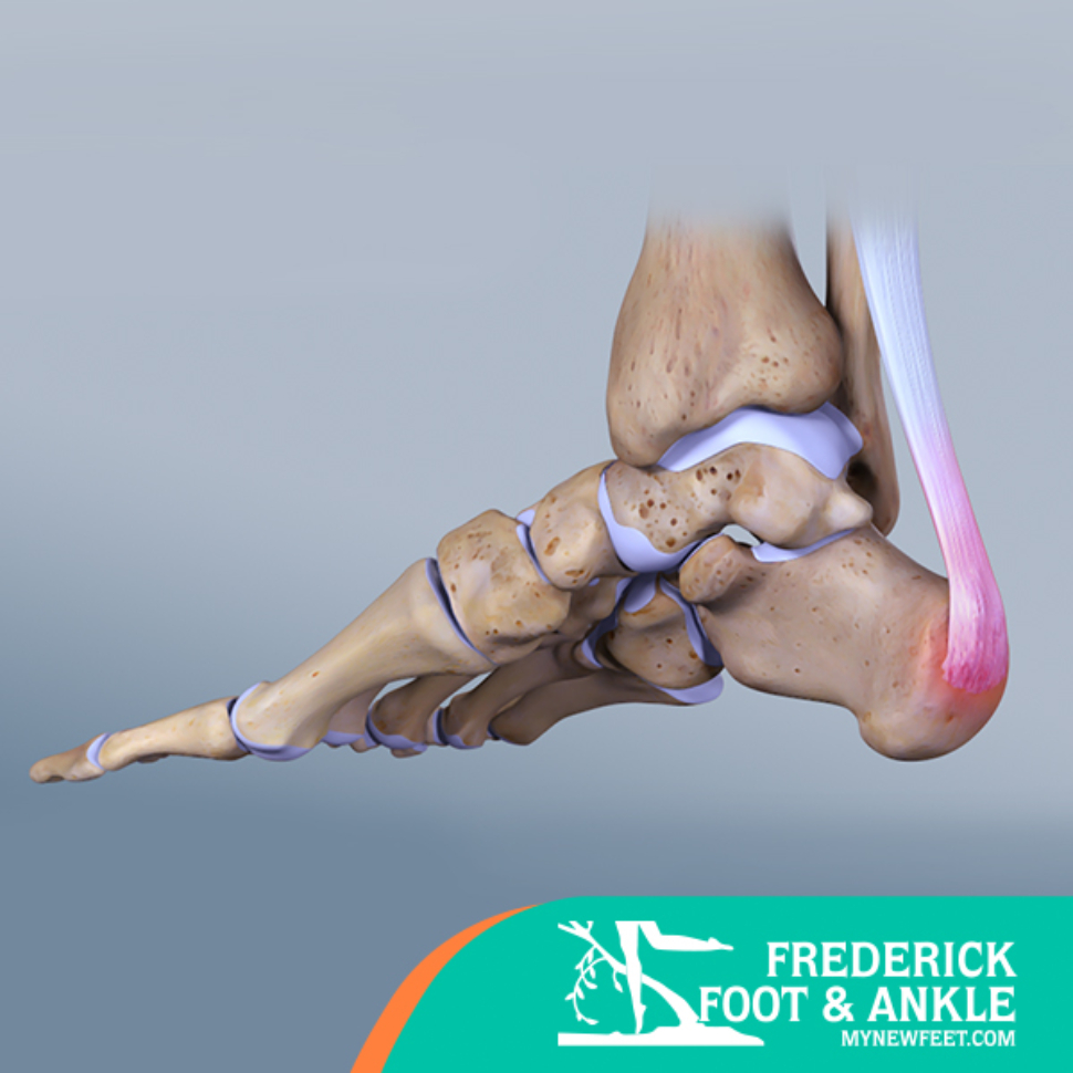 Featured_AchillesTendonitis